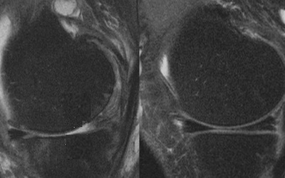 Étude comparative des explorations du genou en IRM à 1,5T et à 3T