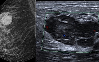 Comparaison des performances diagnostiques de la tomosynthèse et de l'achographie mammaire