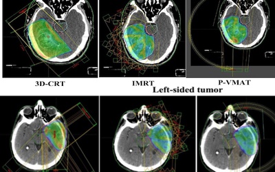 La RC3D suffit-elle pour traiter effficacement le glioblastome en l'absence de RCMI ou de VMAT ?