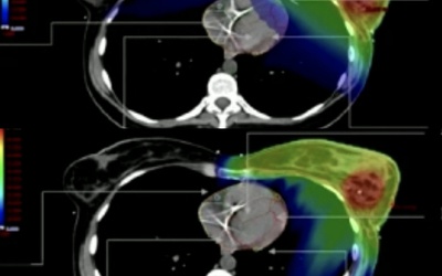 L'EFRS invite les MEM de radiothérapie à participer à une enquête sur leurs pratiques et leur formation