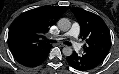 Une méta-analyse des bonnes pratiques en angioscanner pulmonaire