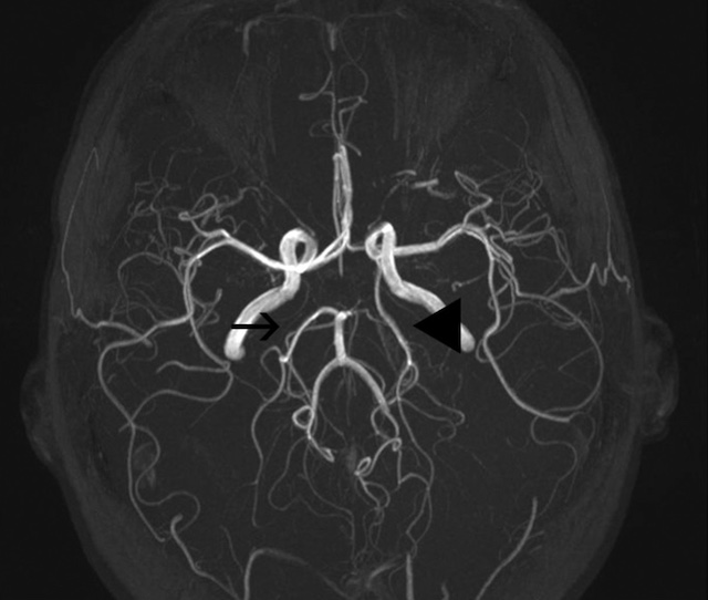 Évaluation par IRM ASL de la perfusion cérébrale en aval d'une artère cérébrale postérieure de type fœtal