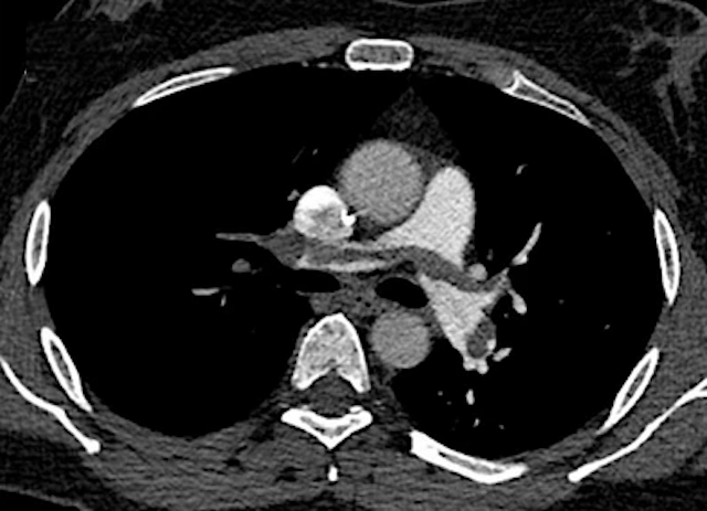 L'angioscanner à faible volume et faible débit jugé efficace dans les cas d'embolie pulmonaire