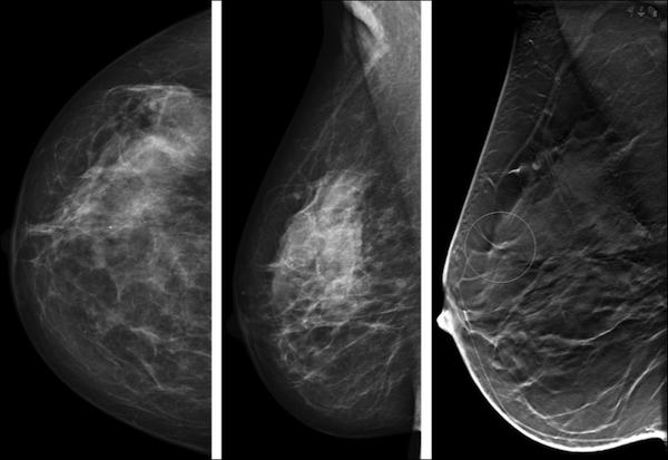 Évaluation du risque lié aux seins denses durant la ménopause par tomosynthèse