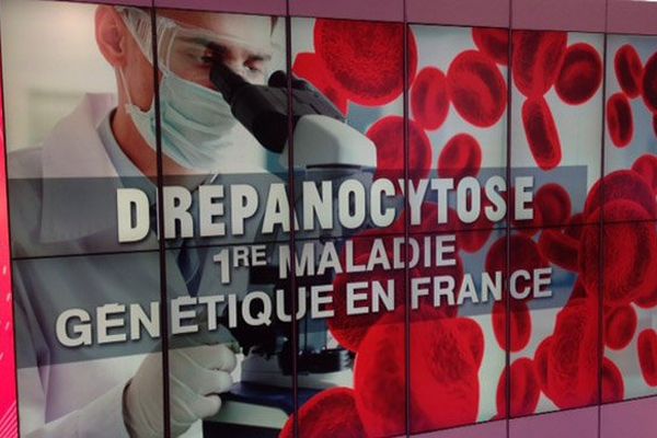 N°343 - Optimisation de l'angioscanner pulmonaire chez le patient drépanocytaire