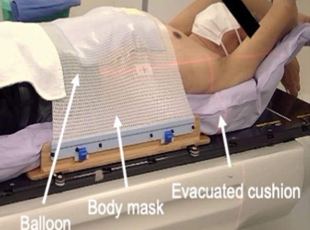 Un masque-ballon abdominal pour une bonne contention lors d'une SBRT du rachis lombaire