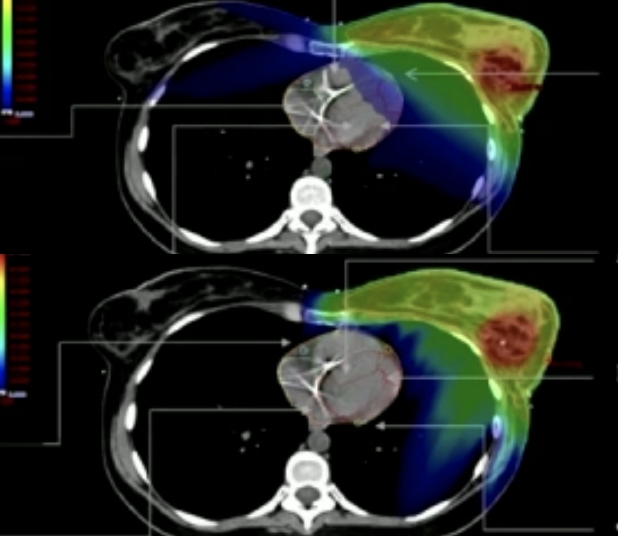 L'EFRS invite les MEM de radiothérapie à participer à une enquête sur leurs pratiques et leur formation