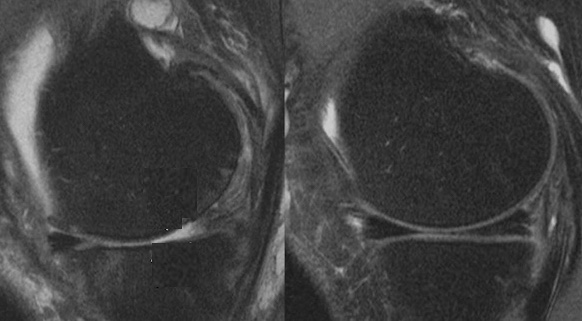 Étude comparative des explorations du genou en IRM à 1,5T et à 3T