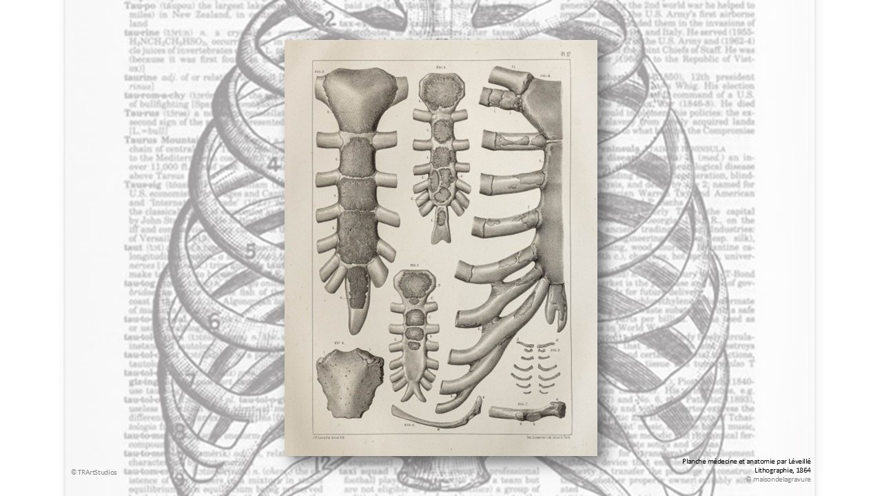 N°363 - Le vissage sternal en radiologie interventionnelle