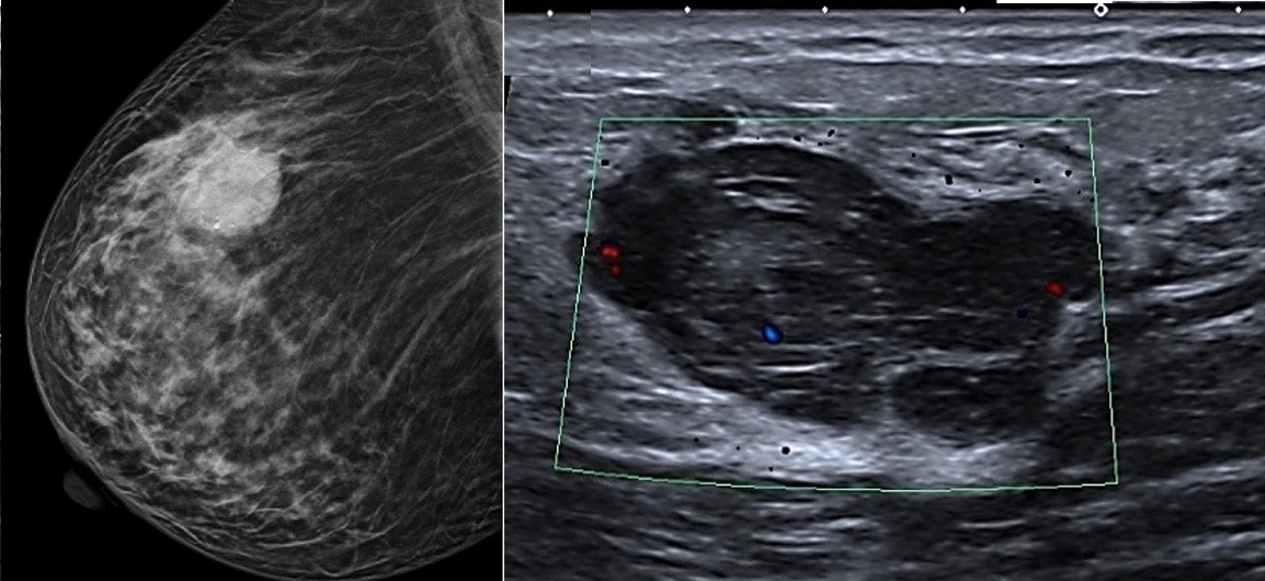 Comparaison des performances diagnostiques de la tomosynthèse et de l'achographie mammaire