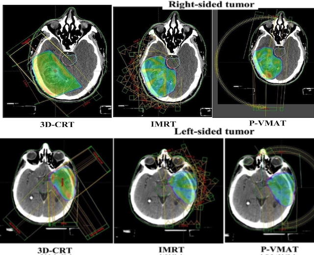 La RC3D suffit-elle pour traiter effficacement le glioblastome en l'absence de RCMI ou de VMAT ?